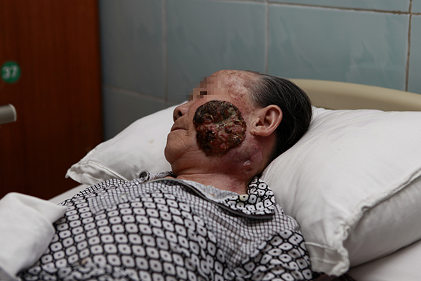 口腔颌面外科团队组织进行了病例讨论:患者长期处于恶病质状态,致精神