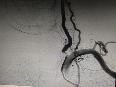 我院神经二内科完成第一例椎动脉狭窄支架植入术