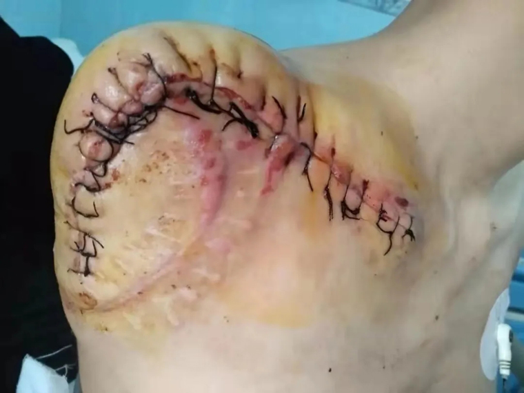 后复发,肩部被巨大肿瘤撑得高高隆起