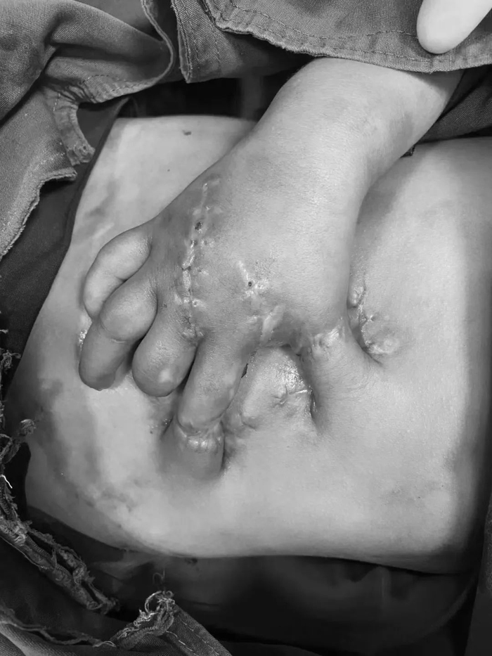 凯里一岁患儿右手因炮炸伤医生把手指种肚上养活了